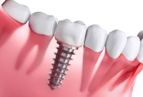 Dental Implants Clinic porbandar