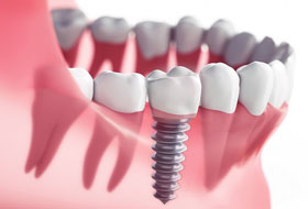 Dental Implants Clinic gujarat