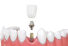 Dental Implant porbandar