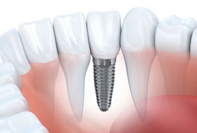 Dental Implant gujarat