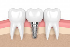 Dental Implant India