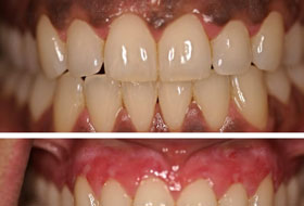 Gum Depigmentation clinic in porbandar
