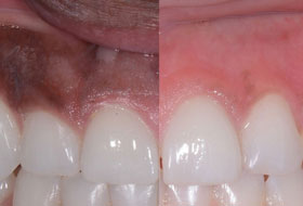 Gum Depigmentation clinic in porbandar