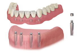implant supported dentures clinic in porbandar