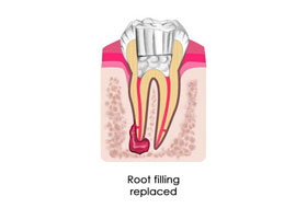 Root Canal Treatment India