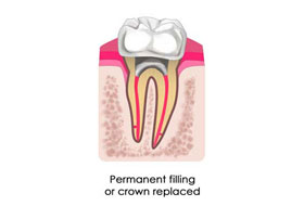Root Canal Treatment in porbandar