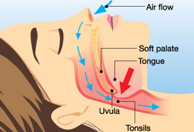 snoring therapy clinic in porbandar
