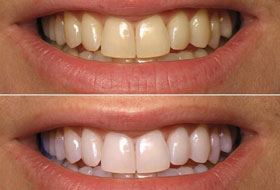 Teeth Whitening clinic porbandar