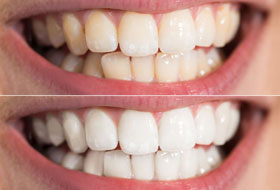 Teeth Whitening clinic gujarat