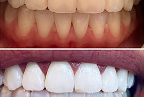 Teeth Whitening in porbandar