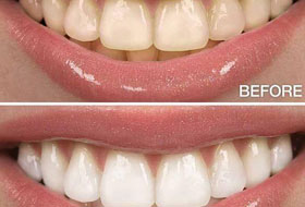 Teeth Whitening in gujarat