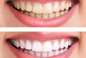 Teeth Whitening porbandar