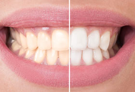 Teeth Whitening dentist