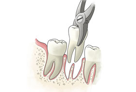 tooth extraction clinic in porbandar