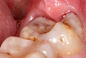 wisdom teeth surgery in porbandar